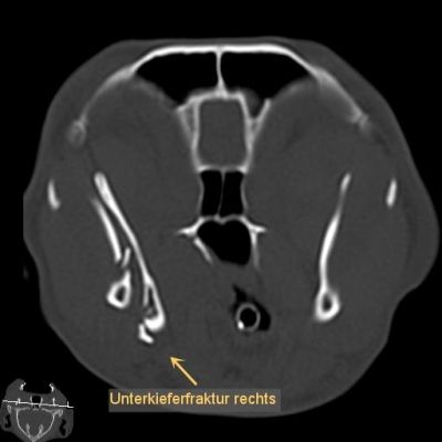 ct-unterkieferfraktur