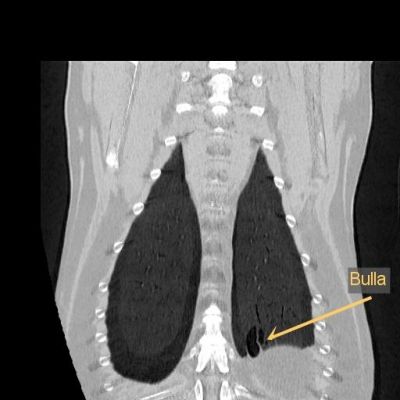 ct-lunge-dorsalschnitt