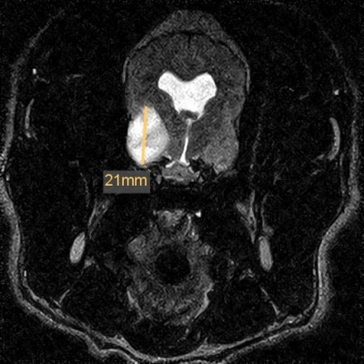gehinr-tumor